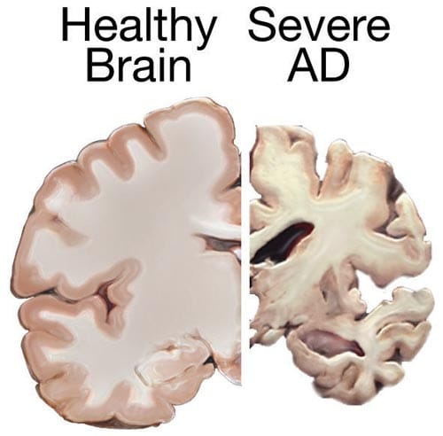 Brain affected by Alzheimer's disease, the physical structures we associate with memory and personality are often badly damag