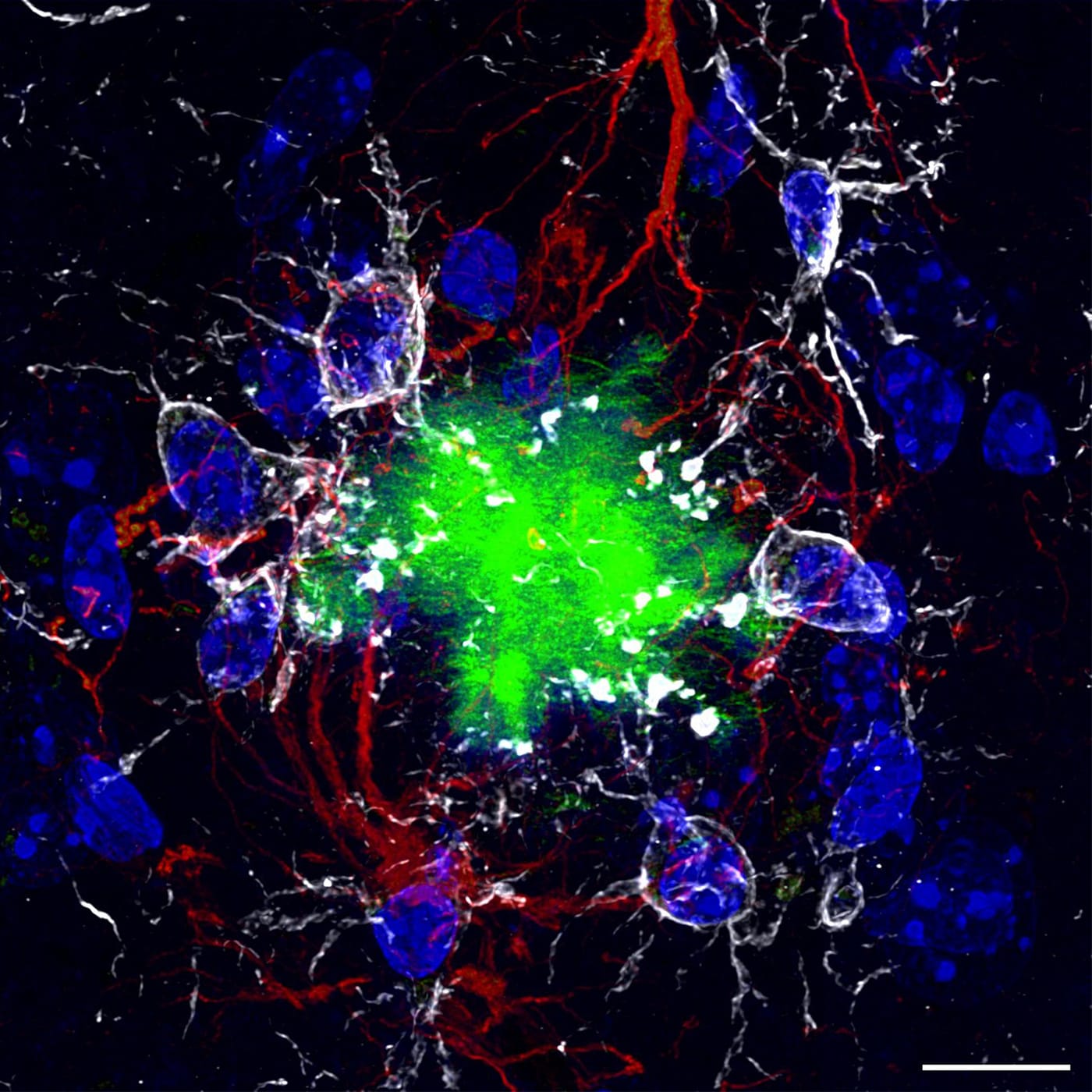 Alzheimer's disease patient's brain, dementia or another severe brain condition