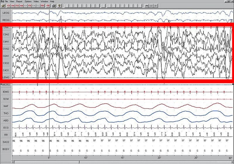 Slow-wave sleep EEG recording, deep, dreamless sleep ... even though the brain is still working